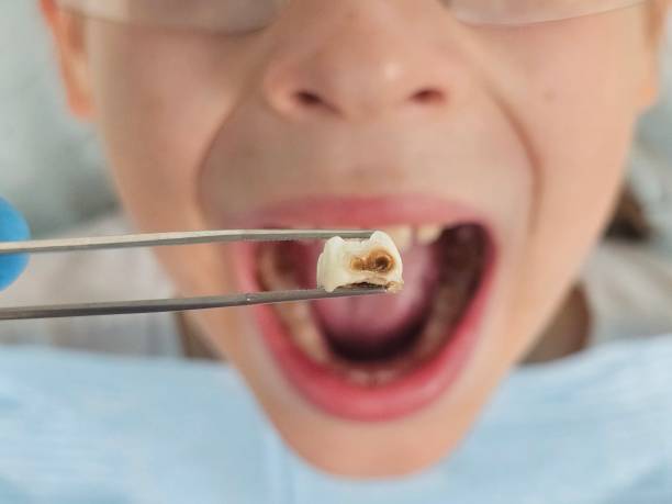 Best Emergency Treatment for Dental Infections or Abscesses in Highlandville, MO